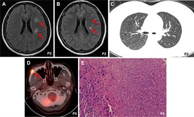 Case Report: Active tuberculosis infection in CAR T-cell recipients post CAR T-cell therapy: a retrospective case series